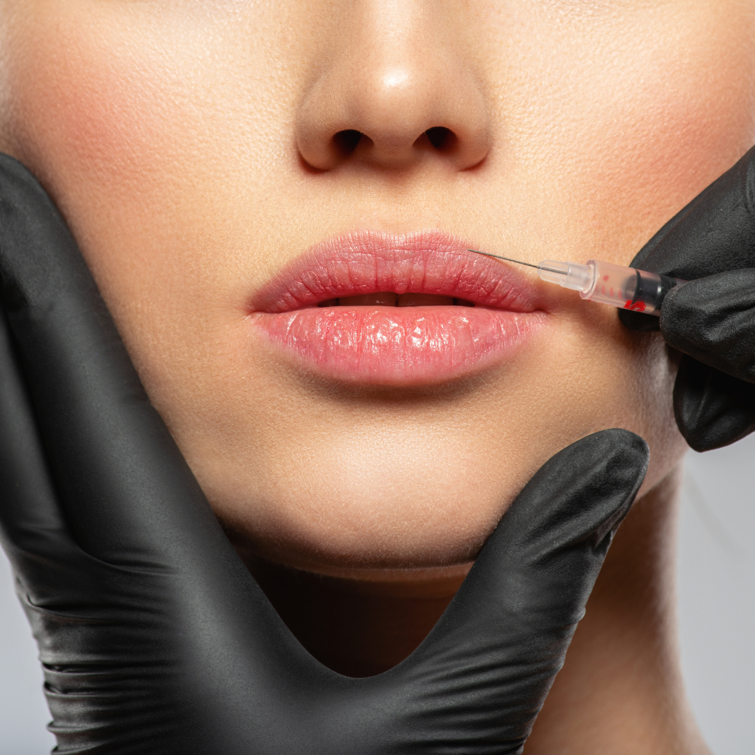 Hyaluronic Acid Fillers