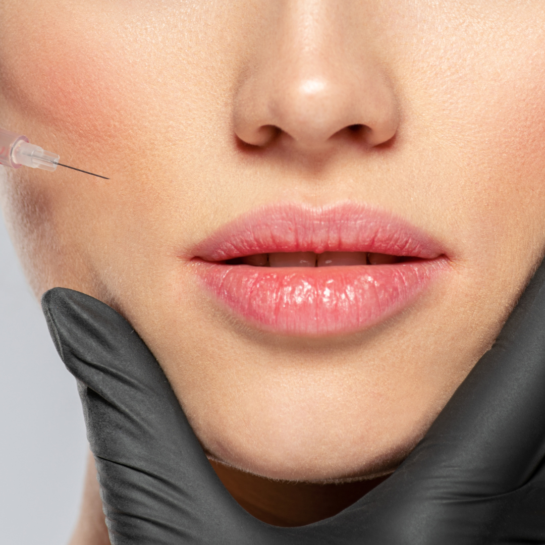 Hyaluronic Acid Fillers