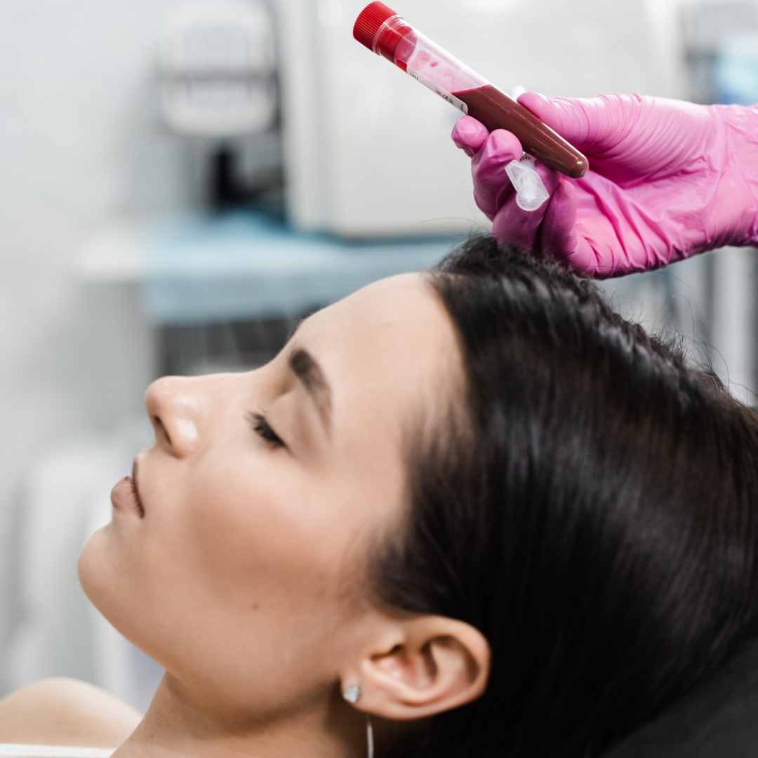 PRP Vampire Facial